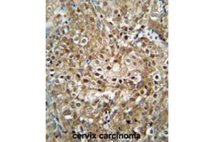 CF153 antibody (C-term) immunohistochemistry analysis in formalin fixed and paraffin embedded human cervix carcinoma followed by peroxidase conjugation of the secondary antibody and DAB staining. (CF153 (AA 233-263), (C-Term) antibody)