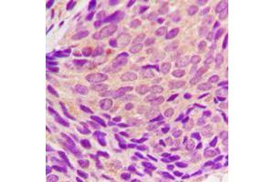 Immunohistochemical analysis of SYK (pY323) staining in human breast cancer formalin fixed paraffin embedded tissue section. (SYK antibody  (pTyr323))