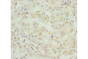 Immunohistochemistry of paraffin-embedded human gastric cancer using ABIN7171149 at dilution of 1:100 (SNAP29 antibody  (AA 1-258))
