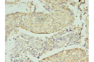 Immunohistochemistry of paraffin-embedded human lung cancer using ABIN7164305 at dilution of 1:100 (Neuregulin 2 antibody  (AA 112-405))