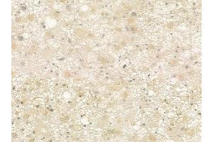 ABIN6265902 and ABIN6273340 at 1/100 staining human astrocytoma by IHC-P.
