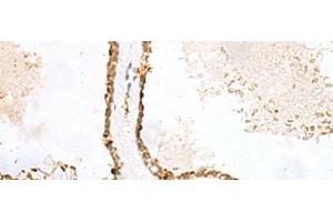 Immunohistochemistry of paraffin-embedded Human thyroid cancer tissue using LPXN Polyclonal Antibody at dilution of 1:60(x200) (Leupaxin antibody)