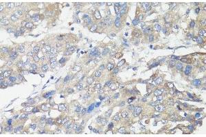 Immunohistochemistry of paraffin-embedded Human liver cancer using MUL1 Polyclonal Antibody at dilution of 1:100 (40x lens). (MUL1 antibody)