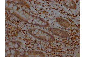 IHC image of ABIN7127612 diluted at 1:100 and staining in paraffin-embedded human colon cancer performed on a Leica BondTM system. (Recombinant MEK1 antibody)