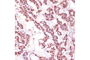 Immunohistochemistry of paraffin-embedded human thyroid cancer using RPL24 antibody (ABIN7269998) at dilution of 1:100 (40x lens). (RPL24 antibody  (AA 38-157))