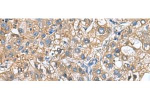 Immunohistochemistry of paraffin-embedded Human liver cancer tissue using IGLL1 Polyclonal Antibody at dilution of 1:65(x200) (IGLL1 antibody)