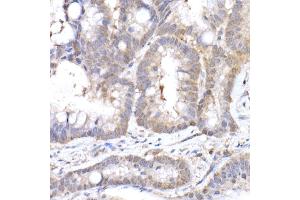 Immunohistochemistry of paraffin-embedded human colon carcinoma using MTAP Rabbit mAb (ABIN7268498) at dilution of 1:50 (40x lens). (MTAP antibody)