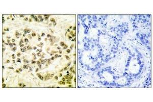 Immunohistochemical analysis of paraffin-embedded human breast carcinoma tissue using STAT5B (phospho-Ser731) antibody. (STAT5B antibody  (pSer731))