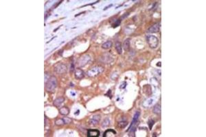Formalin-fixed and paraffin-embedded human cancer tissue reacted with the primary antibody, which was peroxidase-conjugated to the secondary antibody, followed by AEC staining. (PKC mu antibody  (N-Term))