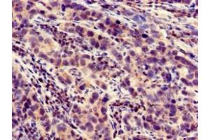 Immunohistochemistry of paraffin-embedded human pancreatic cancer using ABIN7158447 at dilution of 1:100 (LOXHD1 antibody  (AA 1101-1366))