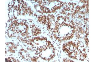 Formalin-fixed, paraffin-embedded human Colon Carcinoma stained with MSH6 Mouse Monoclonal Antibody (MSH6/3086). (MSH6 antibody  (AA 374-540))