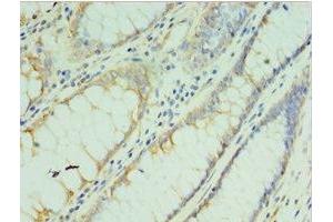 Immunohistochemistry of paraffin-embedded human colon cancer using ABIN7173555 at dilution of 1:100 (TMOD3 antibody  (AA 1-352))