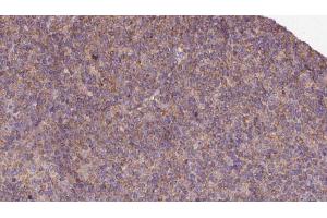 ABIN6273129 at 1/100 staining Human lymph cancer tissue by IHC-P. (KIF12 antibody  (N-Term))