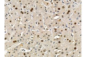ABIN7095507 and ABIN7099564 at 1/100 staining human liver cancer by IHC-P. (CAND1 antibody)