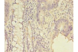 Immunohistochemistry of paraffin-embedded human colon cancer using ABIN7143981 at dilution of 1:100 (SCNN1G antibody  (AA 90-350))