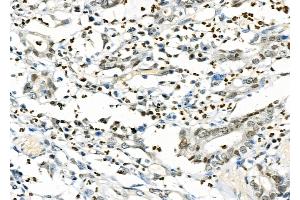 ABIN6261703 and ABIN6277266 at 1/100 staining Human gastric cancer by IHC-P. (CD16 antibody  (C-Term))