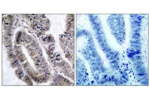 Immunohistochemical analysis of paraffin- embedded human colon carcinoma tissue, using AMPK1/AMPK2 (phospho-Ser485/Ser491) antibody (E011174). (PRKAA1/PRKAA2 antibody  (pSer485, pSer491))
