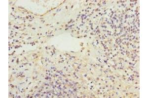 Immunohistochemistry of paraffin-embedded human cervical cancer using ABIN7168321 at dilution of 1:100 (RBMS2 antibody  (AA 1-407))
