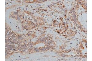 ABIN6268647 at 1/50 staining human lung cancer tissue sections by IHC-P. (TSC1 antibody  (C-Term))