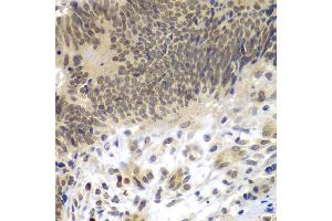 Immunohistochemistry of paraffin-embedded human colon carcinoma using CEBPG antibody (ABIN5974381) at dilution of 1/100 (40x lens). (CEBPG antibody)