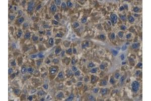 DAB staining on IHC-P; Samples: Human Liver cancer Tissue (CDKN3 antibody  (AA 1-212))