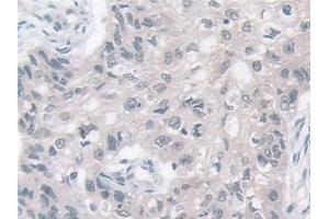 Detection of VAPB in Human Lung cancer Tissue using Polyclonal Antibody to Vesicle Associated Membrane Protein Associated Protein B (VAPB) (VAPB antibody  (AA 1-132))
