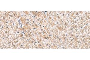 Immunohistochemistry of paraffin-embedded Human liver cancer tissue using HLA-E Polyclonal Antibody at dilution of 1:50(x200) (HLA-E antibody)