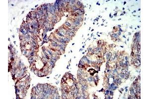 Immunohistochemical analysis of paraffin-embedded rectum cancer tissues using PRKAA2 mouse mAb with DAB staining. (PRKAA2 antibody  (AA 453-552))