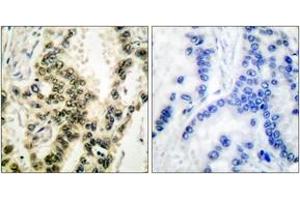 Immunohistochemistry analysis of paraffin-embedded human lung carcinoma, using SRF (Phospho-Ser99) Antibody. (SRF antibody  (pSer103))