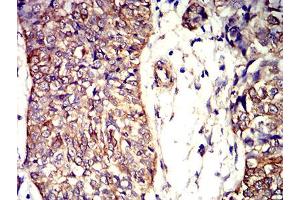 Immunohistochemical analysis of paraffin-embedded bladder cancer tissues using APC2 mouse mAb with DAB staining. (APC2 antibody  (AA 2041-2181))