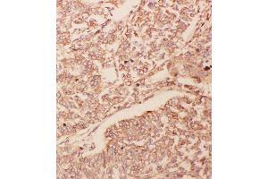 Anti-GDNF antibody, IHC(P) IHC(P): Human Lung Cancer Tissue