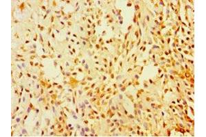 Immunohistochemistry of paraffin-embedded human breast cancer using ABIN7170920 at dilution of 1:100 (SUGCT antibody  (AA 1-250))