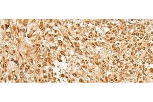 Immunohistochemistry of paraffin-embedded Human liver cancer tissue using JPT2 Polyclonal Antibody at dilution of 1:65(x200) (JPT2 antibody)