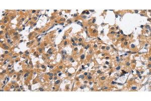 Immunohistochemistry of paraffin-embedded Human thyroid cancer tissue using CLEC2D Polyclonal Antibody at dilution 1:70 (CLEC2D antibody)