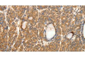 Immunohistochemistry of paraffin-embedded Human thyroid cancer tissue using SYT11 Polyclonal Antibody at dilution 1:30 (SYT11 antibody)