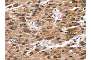 The image on the left is immunohistochemistry of paraffin-embedded Human liver cancer tissue using ABIN7192580(SNTA1 Antibody) at dilution 1/20, on the right is treated with synthetic peptide. (SNTA1 antibody)