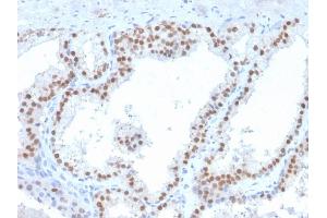Formalin-fixed, paraffin-embedded human prostate carcinoma stained with RET Mouse Monoclonal Antibody (RET/2663).