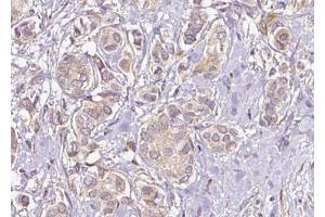ABIN6274740 at 1/100 staining Human breast cancer tissue by IHC-P. (MRPL40 antibody  (C-Term))
