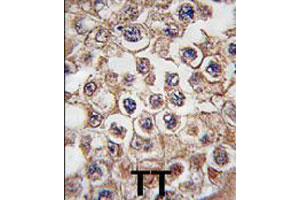 Formalin-fixed and paraffin-embedded human testis tissue reacted with INSRR polyclonal antibody  , which was peroxidase-conjugated to the secondary antibody, followed by DAB staining. (INSRR antibody  (N-Term))