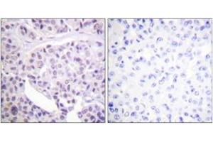 Immunohistochemistry analysis of paraffin-embedded human breast carcinoma tissue, using p53 (Ab-392) Antibody. (p53 antibody  (AA 344-393))