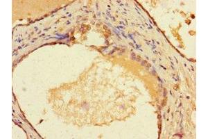 Immunohistochemistry of paraffin-embedded human prostate cancer using ABIN7155576 at dilution of 1:100 (HLA-DMA antibody  (AA 27-233))