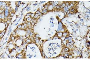 Immunohistochemistry of paraffin-embedded Human colon carcinoma using MTIF2 Polyclonal Antibody at dilution of 1:100 (40x lens). (MTIF2 antibody)