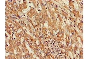 Immunohistochemistry of paraffin-embedded human liver cancer using ABIN7143803 at dilution of 1:100 (ST8SIA5 antibody  (AA 101-376))