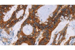 Immunohistochemistry of paraffin-embedded Human colon cancer using GPA33 Polyclonal Antibody at dilution of 1:30 (GPA33 antibody)