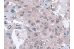 Detection of EXOSC2 in Human Breast cancer Tissue using Polyclonal Antibody to Exosome Component 2 (EXOSC2) (EXOSC2 antibody  (AA 1-293))