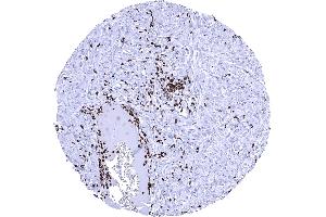 Numerous MPO positive intravascular and stromal granulocytes are seen in a squamous cell carcinoma of the oral cavity (Myeloperoxidase antibody)
