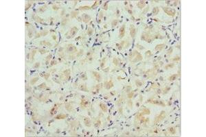Immunohistochemistry of paraffin-embedded human gastric cancer using ABIN7146127 at dilution of 1:100 (CXCL14 antibody  (AA 35-111))