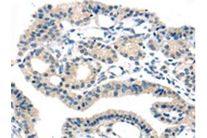 The image on the left is immunohistochemistry of paraffin-embedded Human thyroid cancer tissue using ABIN7192395(SLC16A11 Antibody) at dilution 1/25, on the right is treated with synthetic peptide. (SLC16A11 antibody)