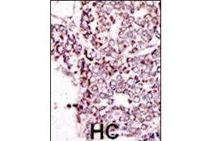 Formalin-fixed and paraffin-embedded human cancer tissue reacted with the primary antibody, which was peroxidase-conjugated to the secondary antibody, followed by DAB staining. (TYRO3 antibody  (C-Term))
