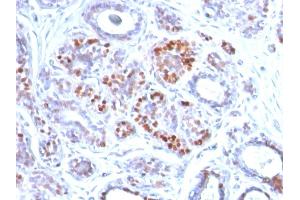 Formalin-fixed, paraffin-embedded human Breast Carcinoma stained with GATA-3 Mouse Monoclonal Antibody (GATA3/2442). (GATA3 antibody  (AA 357-436))